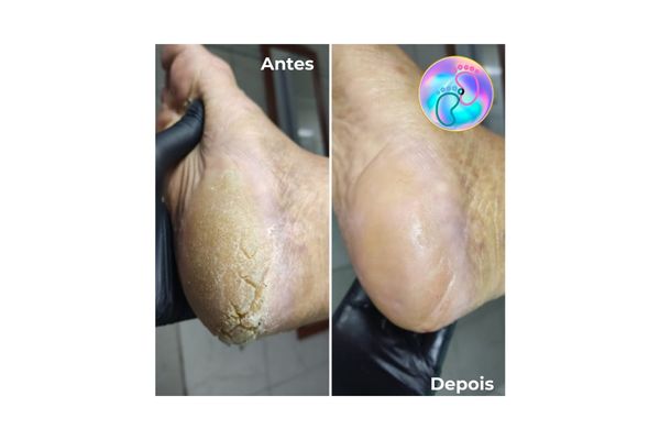 antes e depois 2 